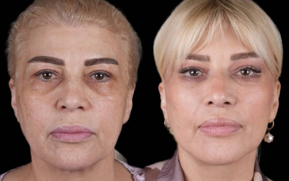 Mətanət İsgəndərli plastik əməliyyatla belə dəyişdi