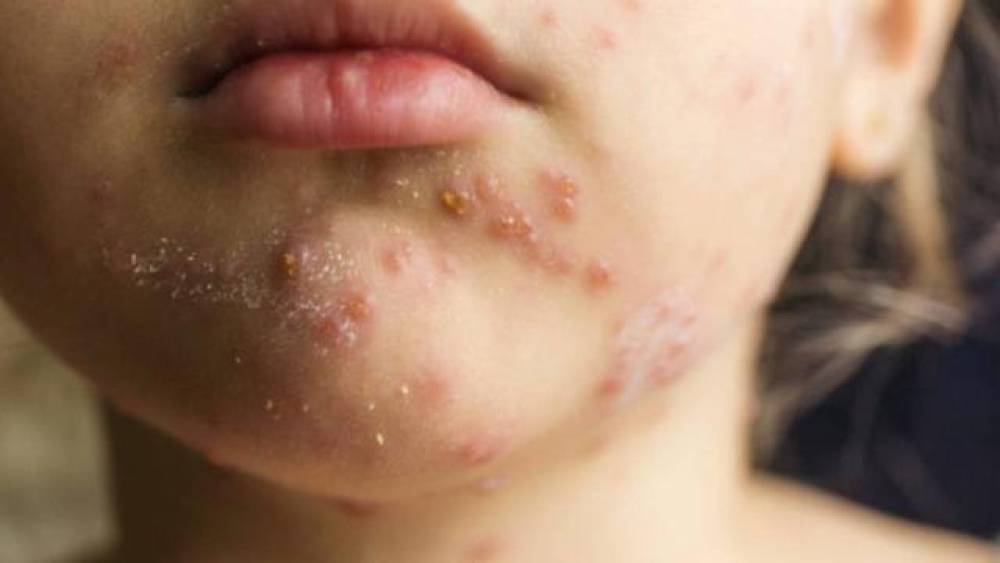 Banqladeşdə qızılca epidemiyasından ölənlərin sayı artdı